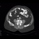 Unknown pathology, secondary finding, small bowel: CT - Computed tomography
